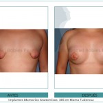 100_Implantes-Mamarios-Anatomicos--385-en-Mama-Tuberosa