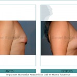 103_Implantes-Mamarios-Anatomicos--385-en-Mama-Tuberosa