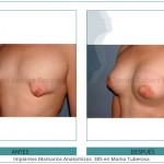 101_Implantes-Mamarios-Anatomicos--385-en-Mama-Tuberosa